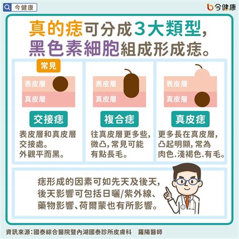 生黑痣|痣是什麼？一次了解痣原因、就醫時機以及如何改善